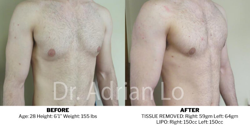 Before And After Gynecomastia Correction - Philadelphia, Pa - Dr 