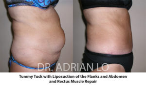 Tummy Tuck (Abdominoplasty) in Philadelphia, PA - Dr. Adrian Lo