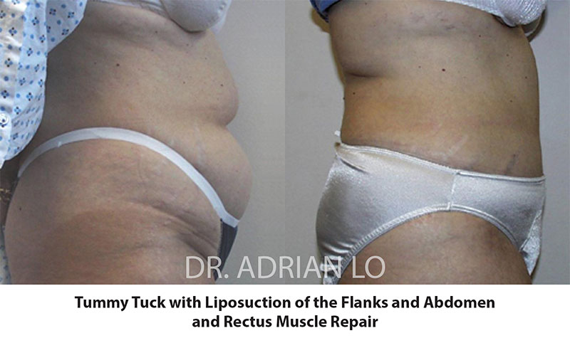 Before and After Tummy Tuck - Philadelphia, PA - Dr. Adrian Lo