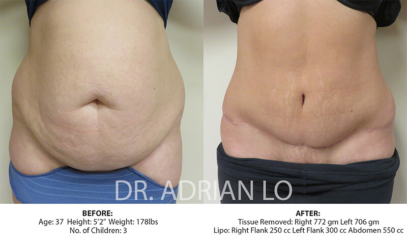 Tummy Tuck, Philadelphia, PA